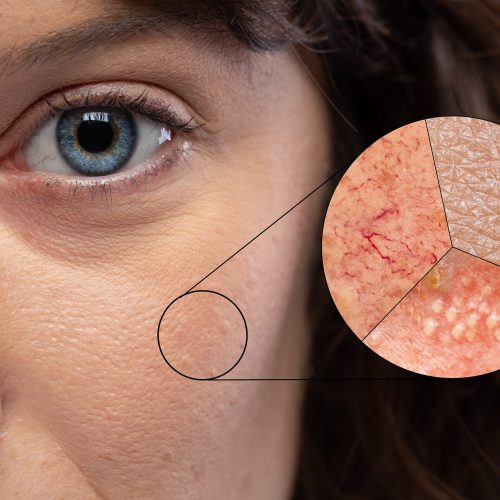 Enlarged view of the skin showing redness for rosacea, dry skin and pimples due to Herpes virus